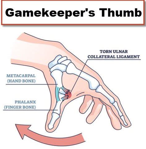Gamekeeper's Thumb Treatment