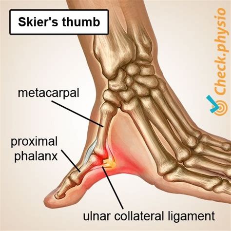 Skier's Thumb Anatomy